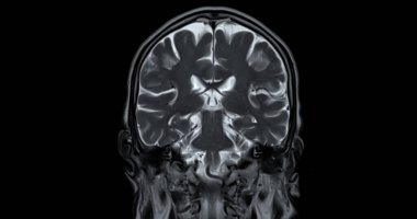 Beyin hastalıklarını tespit etmek için MR taraması. Felç, beyin tümörleri ve enfeksiyonlar gibi..