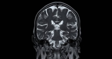 Beyin hastalıklarını tespit etmek için MR taraması. Felç, beyin tümörleri ve enfeksiyonlar gibi..