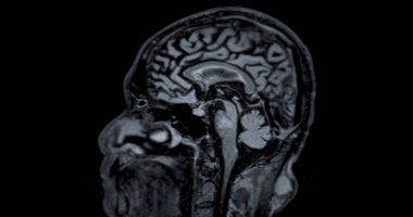 Beyin hastalıklarını tespit etmek için MR taraması. Felç, beyin tümörleri ve enfeksiyonlar gibi..