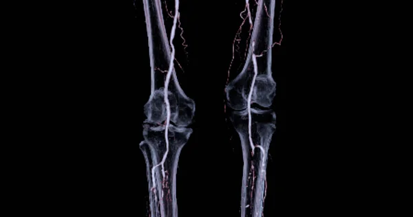 Cta大腿骨動脈は 診断のための大腿骨動脈の画像を実行します急性または慢性末梢動脈疾患 — ストック写真
