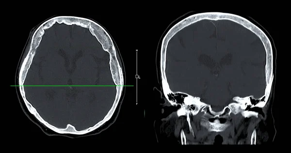 CT scan of the brain sagittal view  for diagnosis brain tumor,stroke diseases and vascular diseases.