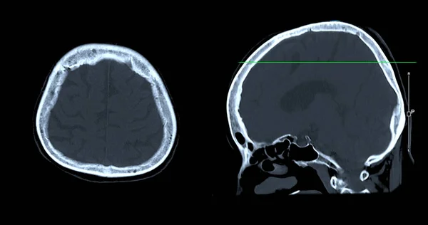 CT scan of the brain sagittal view  for diagnosis brain tumor,stroke diseases and vascular diseases.