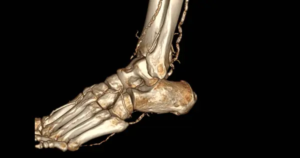 Foot 3D Scan for diagnosis foot diseases by CT-SCANNER .