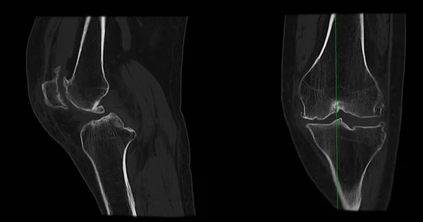 Scan Knee Joint Showing Fracture Tibia Fibula Bone Rendering — Foto ...