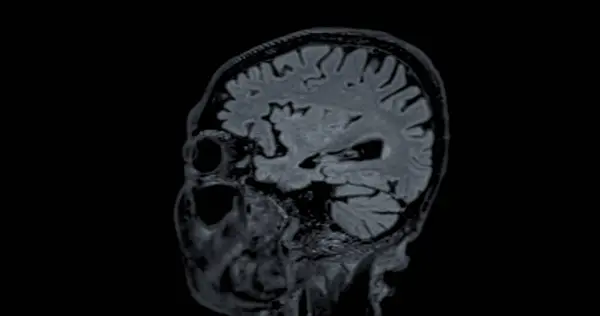 MRI scan of the  brain   for detect  Brain  diseases sush as stroke disease, Brain tumors and Infections.