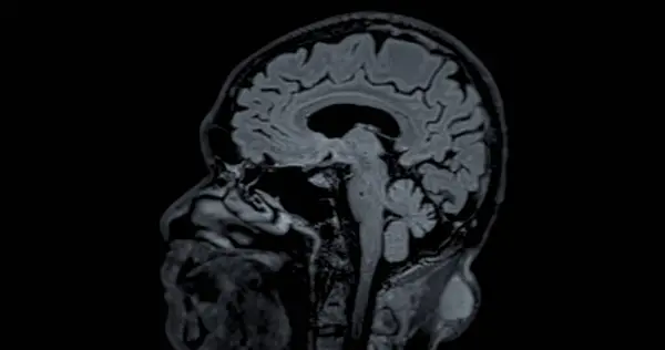MRI scan of the  brain   for detect  Brain  diseases sush as stroke disease, Brain tumors and Infections.