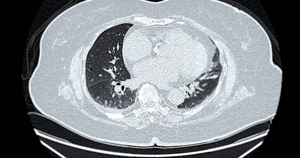 stock image CT scan of Chest axial view for diagnostic Pulmonary embolism (PE) , lung cancer and covid-19. 