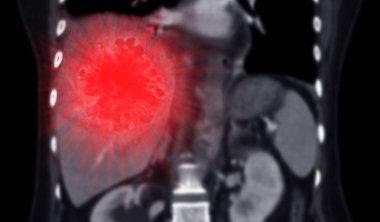 Tomografi üst karın koronal görüntüsü DDX 'in atipik HCC veya hepatosel karsinom olduğunu gösteriyor..