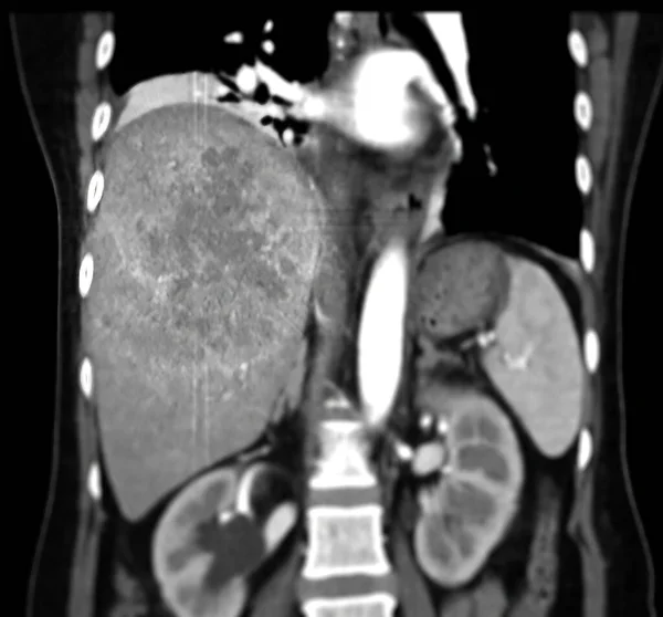 Ddxを示すCtの上部腹部角質は非定型Hccまたは肝細胞がん腫である — ストック写真