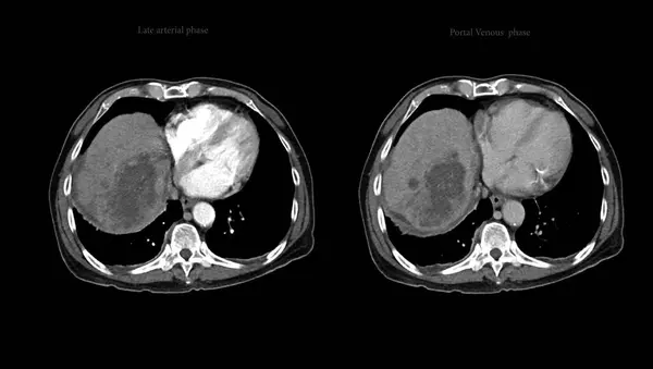 Ct上腹部Ddxは非定型Hccまたは肝細胞がんである — ストック写真
