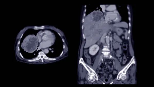 Ct上腹部Ddxは非定型Hccまたは肝細胞がんである — ストック写真