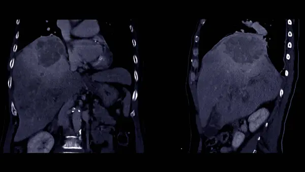 Ddxが非定型Hccまたは肝細胞がんを示すCtの上部腹部角および角形ビュー — ストック写真
