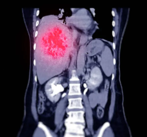 Ddxが非定型Hccまたは肝細胞がんを示すCt上腹部角形ビュー — ストック写真
