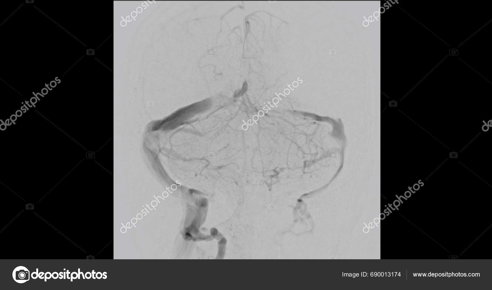 cerebral-angiogram-medical-imaging-procedure-used-examine-blood-vessels