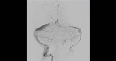 Serebral anjiyogram, beyindeki kan damarlarını incelemek için kullanılan tıbbi bir görüntüleme yöntemidir. Bu prosedür anevrizma, felç ya da damar anormallikleri gibi durumların teşhis edilmesine yardımcı olur..