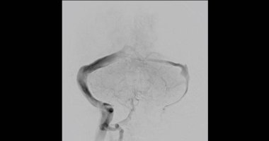 Serebral anjiyogram, beyindeki kan damarlarını incelemek için kullanılan tıbbi bir görüntüleme yöntemidir. Bu prosedür anevrizma, felç ya da damar anormallikleri gibi durumların teşhis edilmesine yardımcı olur..