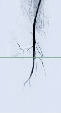 Femoral anjiyogram kasık bölgesindeki kan damarlarını görselleştirmek için kullanılan tıbbi bir işlemdir..