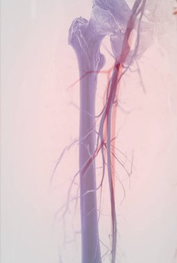 Femoral anjiyogram kasık bölgesindeki kan damarlarını görselleştirmek için kullanılan tıbbi bir işlemdir..