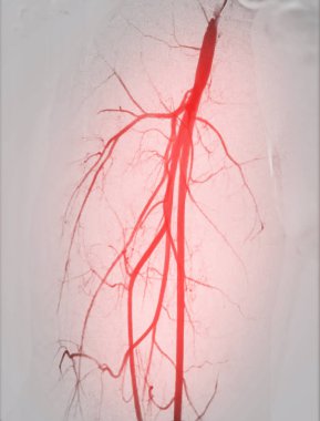 Femoral anjiyogram kasık bölgesindeki kan damarlarını görselleştirmek için kullanılan tıbbi bir işlemdir..