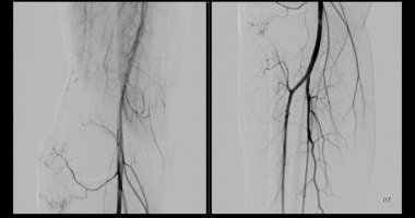 Femoral anjiyogram kasık bölgesindeki kan damarlarını görselleştirmek için kullanılan tıbbi bir işlemdir..