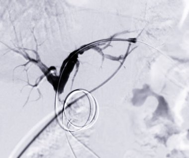 Perkütaneous Transhepatic Biliary Drainage (PTBD) safra kanalı tıkanıklığının tedavisinde kullanılan tıbbi bir işlemdir..