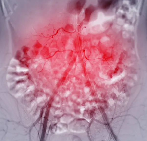 stock image A Femoral Angiogram is a medical procedure used to visualize blood vessels in the groin area.