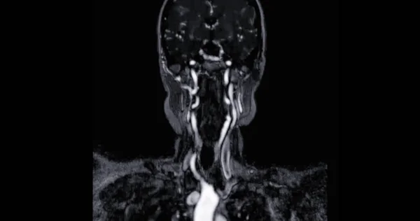脳動脈のMra脳と首または磁気共鳴血管造影 Mra とそれらの狭窄や脳卒中疾患を評価するための一般的な心臓動脈 — ストック写真