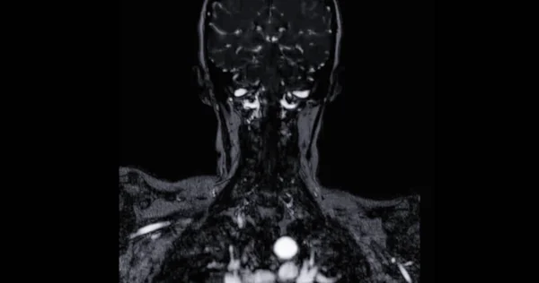 脳動脈のMra脳と首または磁気共鳴血管造影 Mra とそれらの狭窄や脳卒中疾患を評価するための一般的な心臓動脈 — ストック写真
