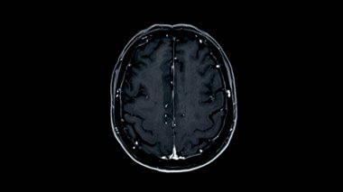 MRI beyin taramaları eksen görüşü doğru tıbbi değerlendirmeler için beyin anatomisi, fonksiyon ve patoloji hakkında değerli bilgiler sunar..