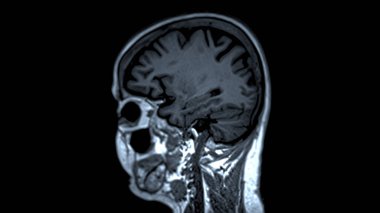 MRI beyin taramaları sagittal görüş, doğru tıbbi değerlendirmeler için beyin anatomisi, fonksiyon ve patoloji hakkında değerli bilgiler sunar..