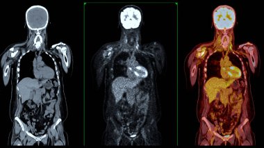 PET Tomografi füzyon görüntüsü PET 'in metabolik aktivitesini tomografideki anatomik bilgilerle birleştirerek detaylı görüntüler sağlar..