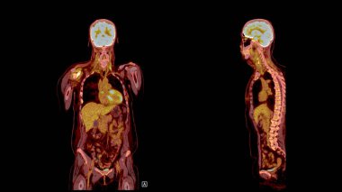 PET Tomografi füzyon görüntüsü PET 'in metabolik aktivitesini tomografideki anatomik bilgilerle birleştirerek detaylı görüntüler sağlar..