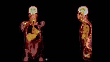 PET Tomografi füzyon görüntüsü PET 'in metabolik aktivitesini tomografideki anatomik bilgilerle birleştirerek detaylı görüntüler sağlar..