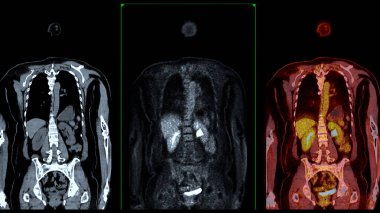 PET Tomografi füzyon görüntüsü PET 'in metabolik aktivitesini tomografideki anatomik bilgilerle birleştirerek detaylı görüntüler sağlar..