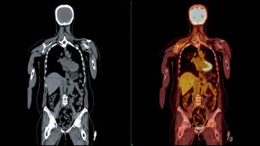 PET Tomografi füzyon görüntüsü PET 'in metabolik aktivitesini tomografideki anatomik bilgilerle birleştirerek detaylı görüntüler sağlar..