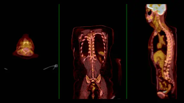 Pet Ctスキャン融合画像 それはCtスキャンからの解剖学的情報をPetから代謝活性を融合させることによって詳細なイメージを提供します — ストック写真