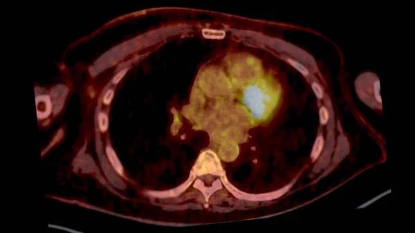 PET CT Scan fusion image It provides detailed images by merging metabolic activity from PET with anatomical information from CT scans.
