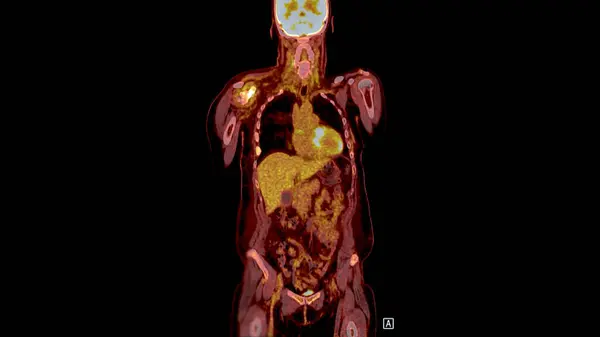 Pet Scan Fusion Image Provides Detailed Images Merging Metabolic Activity — Stock Photo, Image