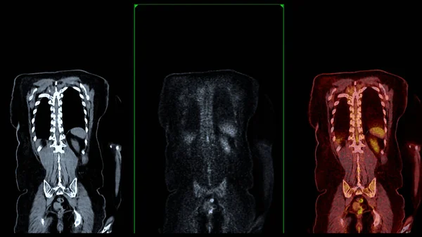 Pet Scan Fusion Image Provides Detailed Images Merging Metabolic Activity — Stock Photo, Image