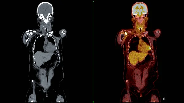 Pet Ctスキャン融合画像 それはCtスキャンからの解剖学的情報をPetから代謝活性を融合させることによって詳細なイメージを提供します — ストック写真