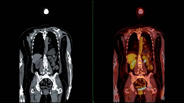 PET CT Scan fusion image It provides detailed images by merging metabolic activity from PET with anatomical information from CT scans.