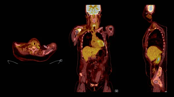 PET CT Scan fusion image It provides detailed images by merging metabolic activity from PET with anatomical information from CT scans.