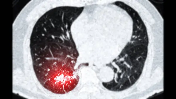 stock image CT scan of Chest or lung  axial viewshowing lung cancer lung cancer .