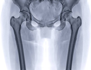 An X-ray reveals both hip joints in normal study. clipart