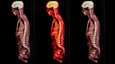 PET-CT tarama resmi, Pozitron Emisyon Tomografisi (PET) ve Bilgisayarlı Tomografi 'nin (CT) kanser yinelemesinin bulunmasına yardımcı olması için bir tanısal görselleştirmedir..