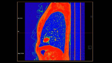 Pulmoner embolizma (PE), akciğer kanseri ve covid-19 için renk modunda göğüs sagital görüntüsünün CT taraması. 