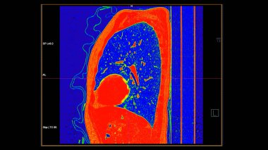Pulmoner embolizma (PE), akciğer kanseri ve covid-19 için renk modunda göğüs sagital görüntüsünün CT taraması. 