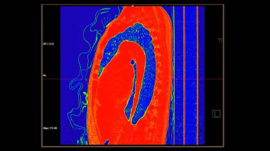 Pulmoner embolizma (PE), akciğer kanseri ve covid-19 için renk modunda göğüs sagital görüntüsünün CT taraması. 