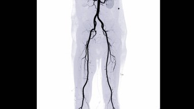 CTA femoral artery run off image of femoral artery for diagnostic Acute or Chronic Peripheral Arterial Disease. clipart