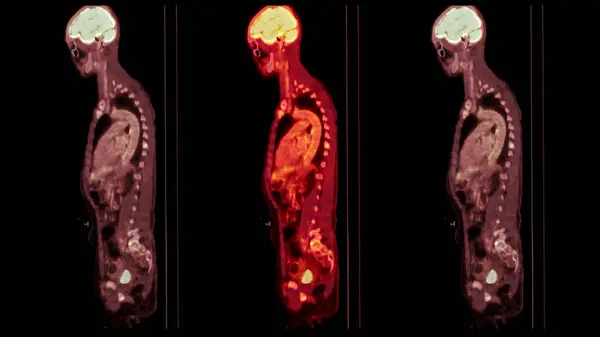 Pet Ctスキャン画像は ポジトロンのエミッショントモグラフィ Pet がん再発を発見するためのヘルプのための計算トモグラフィ を組み合わせた診断可視化です — ストック写真